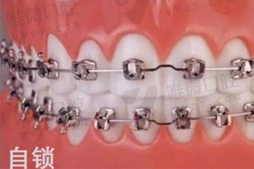 大牙两个假牙的区别图解,烤瓷牙套里的牙会烂吗(图1)